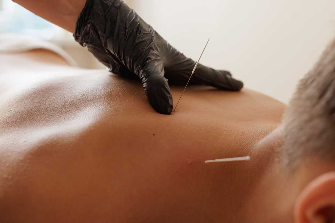 AI image of a gloved hand putting long, thin needles into a man's bare back