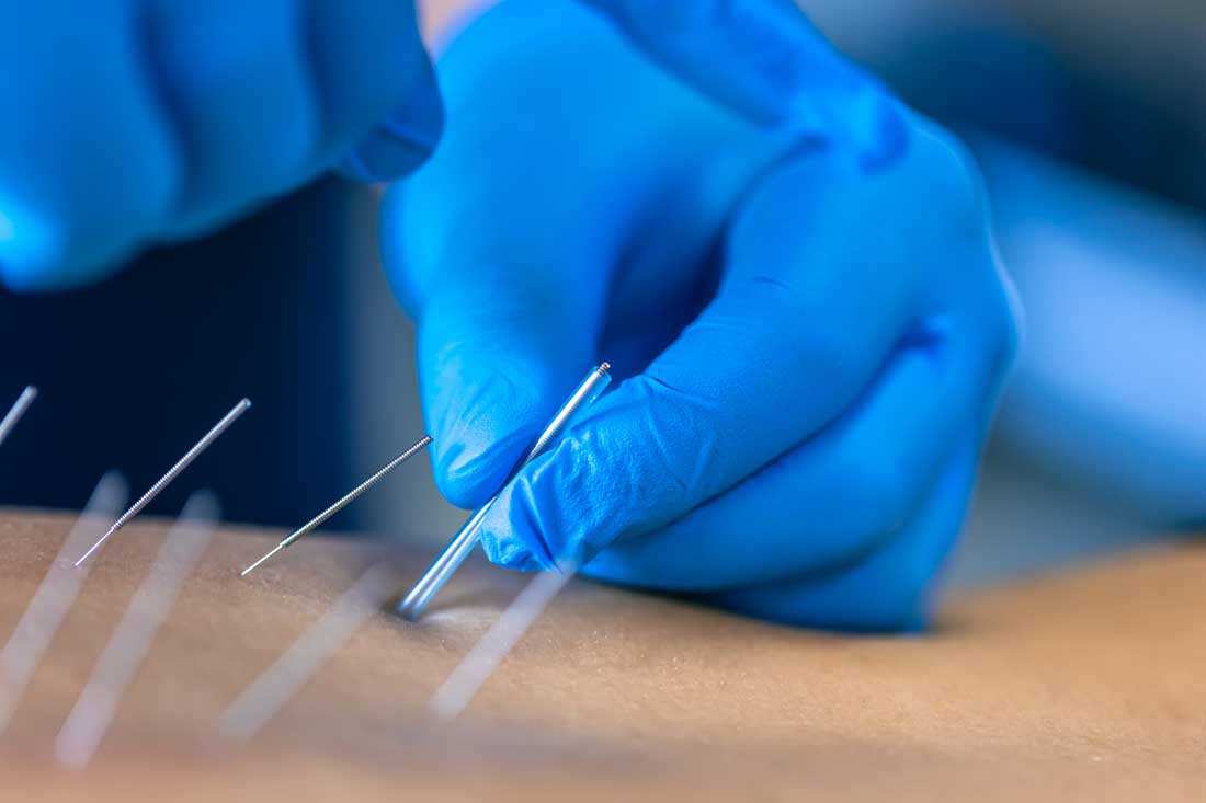 Gloved hands placing a long, thin acupuncture needle into someone's bare back